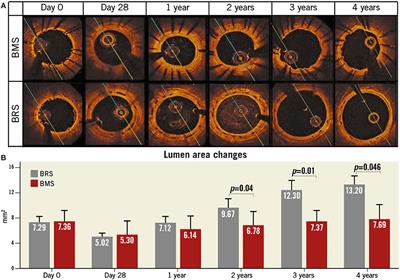 Bioresorbable Scaffolds: Contemporary Status and Future Directions